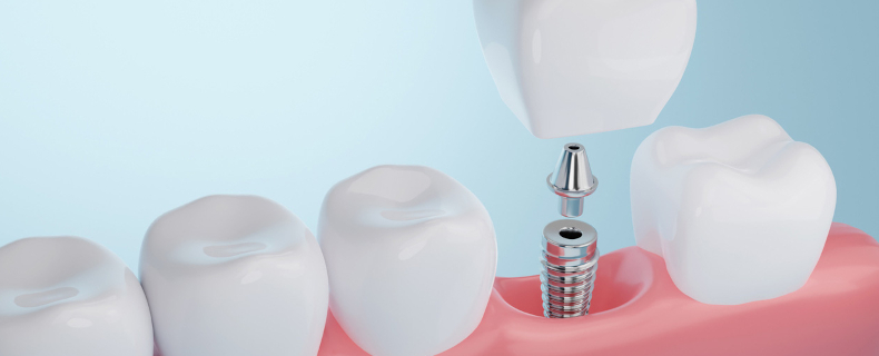 Dental implant